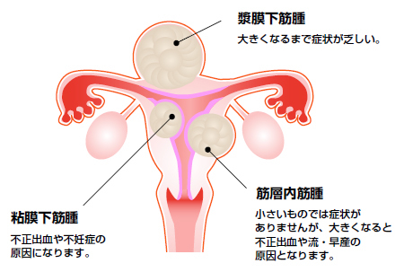 子宮筋腫の症状 原因について 不妊症の情報サイト